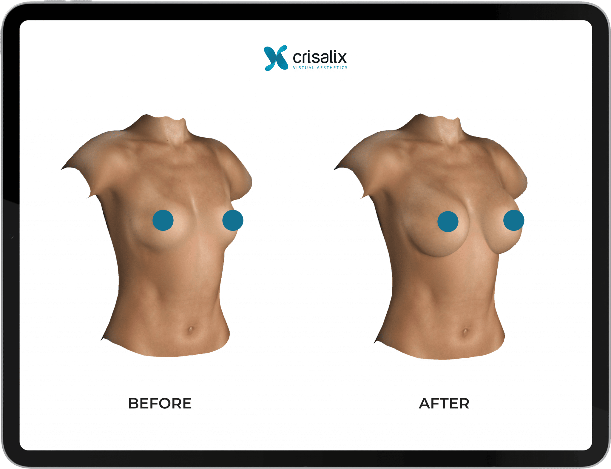 3D breast censored