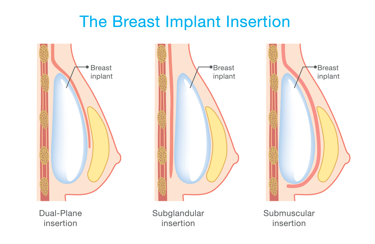 Breast implant placement - Under muscle, Over muscle, Dual plane