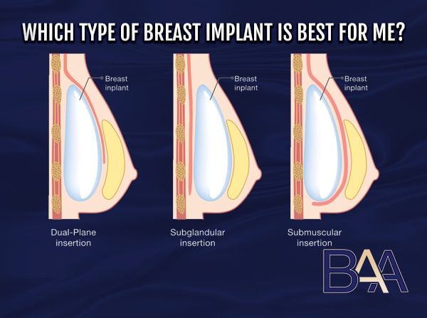 Which Type of Breast Implant is Best for Me?