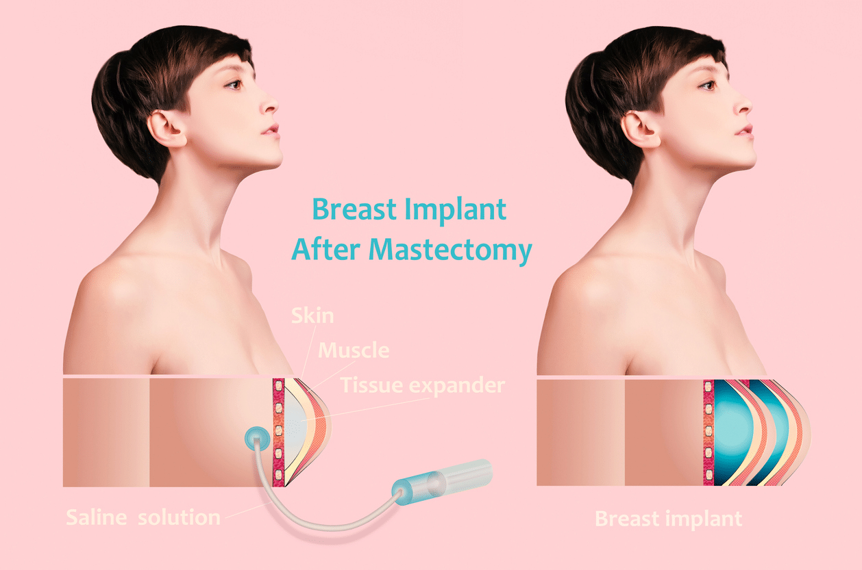 Breast Implant expander