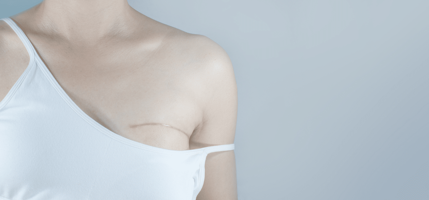 Mastectomy scar