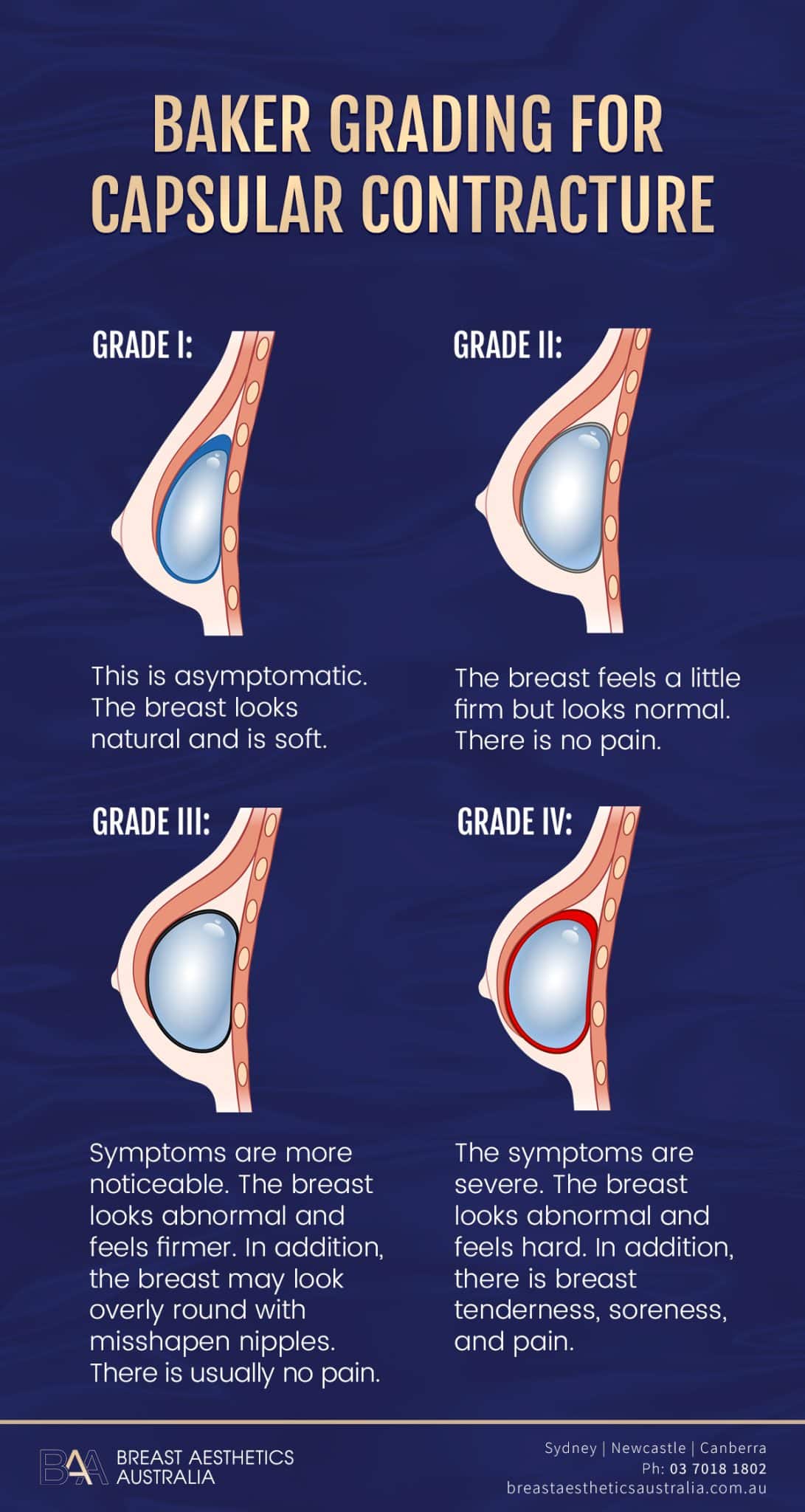 BAA Baker Grading for capsular contracture