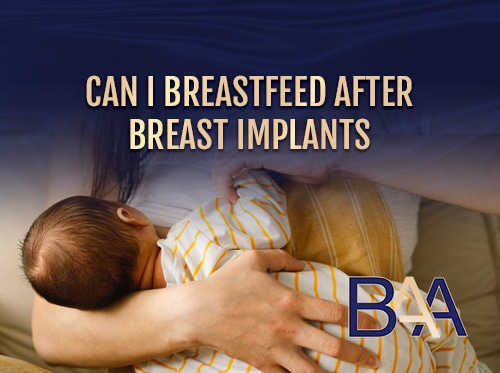 Can I Breastfeed After Breast Implants