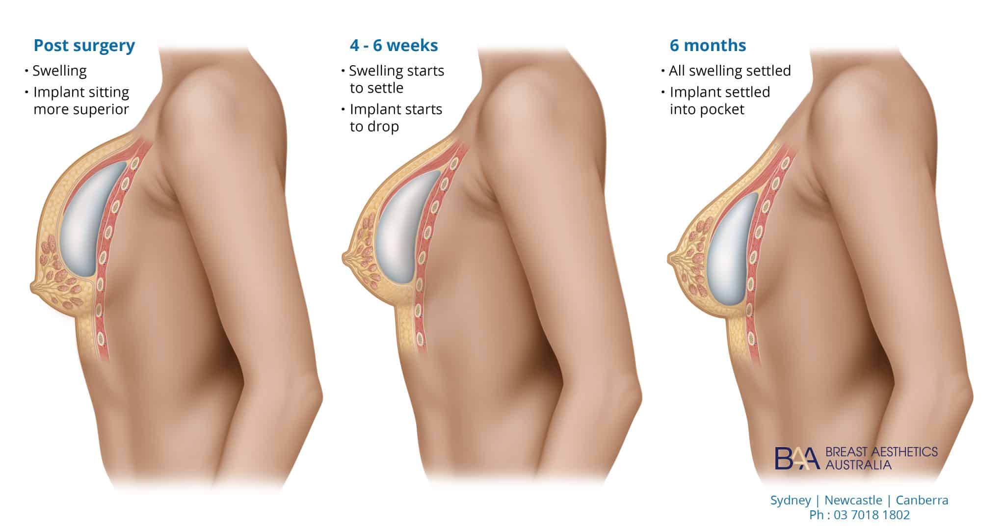 Swelling after breast augmentation 