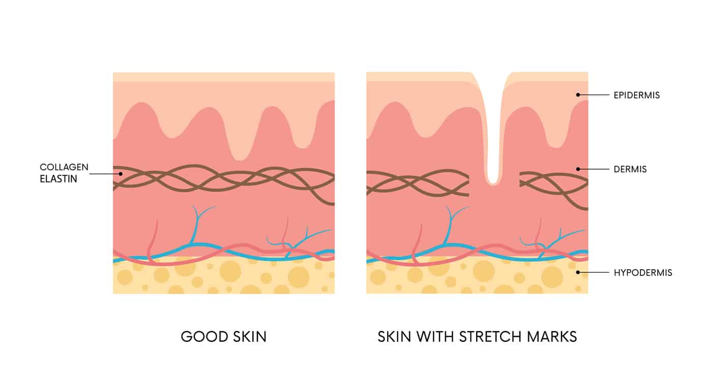 Stretch marks before and after