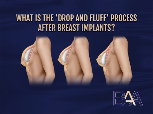 The Breast Implant Drop and Fluff Process Explained