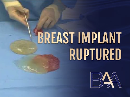Breast Implant Rupture