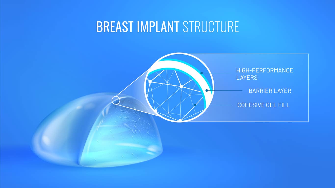 Breast Implant Structure