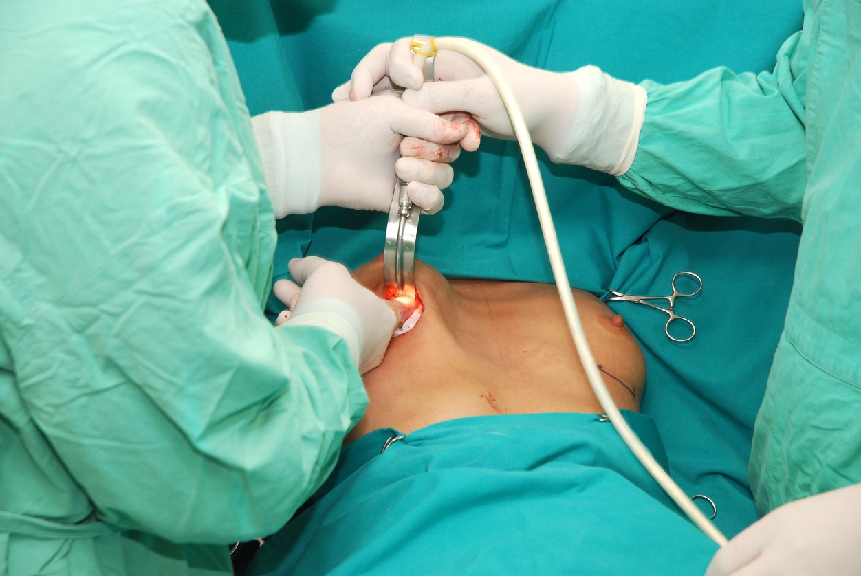 Explantation Surgery