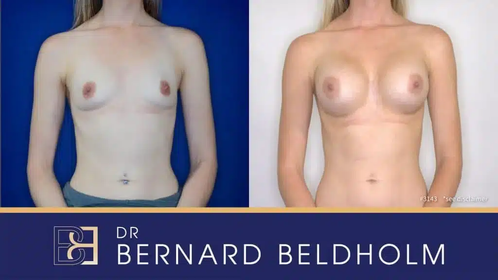 Teardrop - Breast Implants - 400cc to 499cc - Before & After 3143