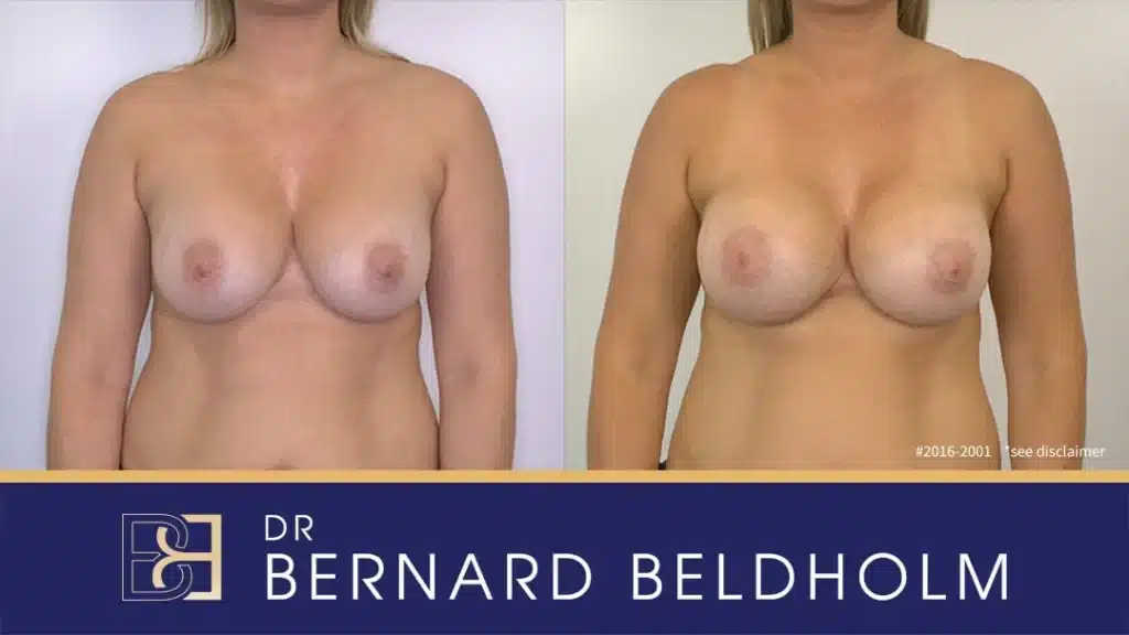 Patient 2016 2001 Removal and replacement of breast implants Front