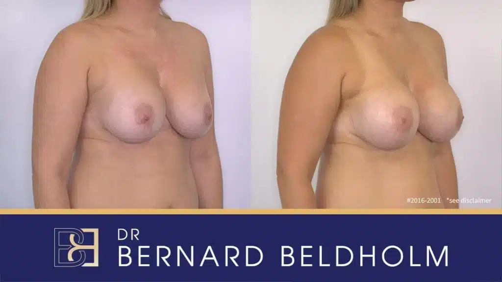 Patient 2016 2001 Removal and replacement of breast implants Left