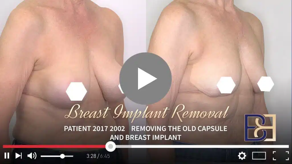 Patient 2017 2002 Removal of breast implants Drip Thumbnail