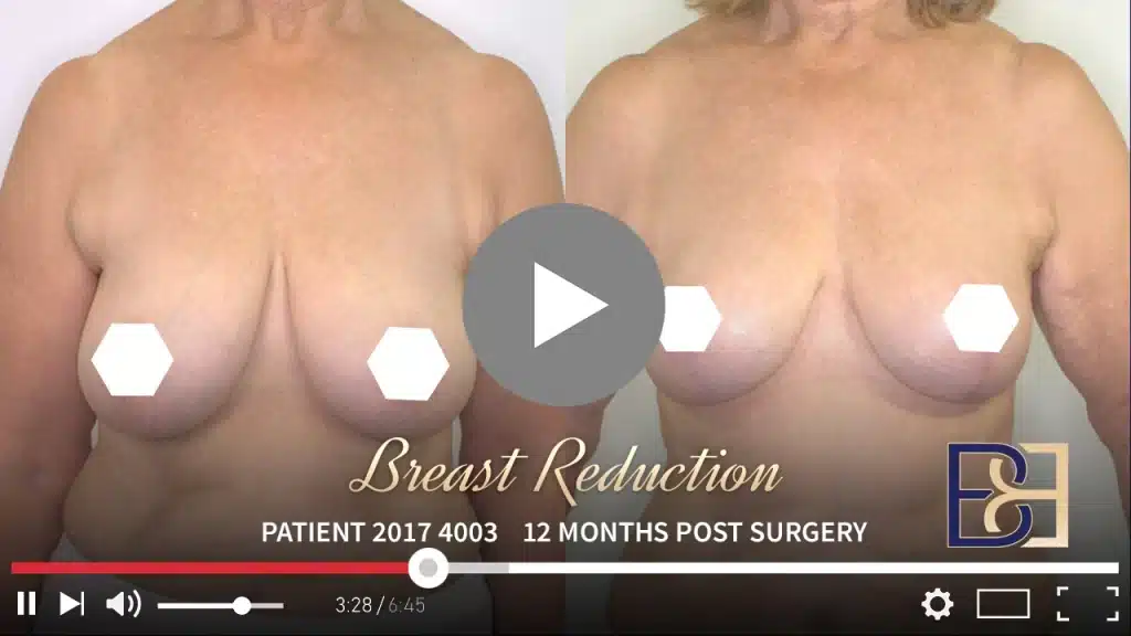 Patient 2017 4003 Breast Reduction Thumbnail