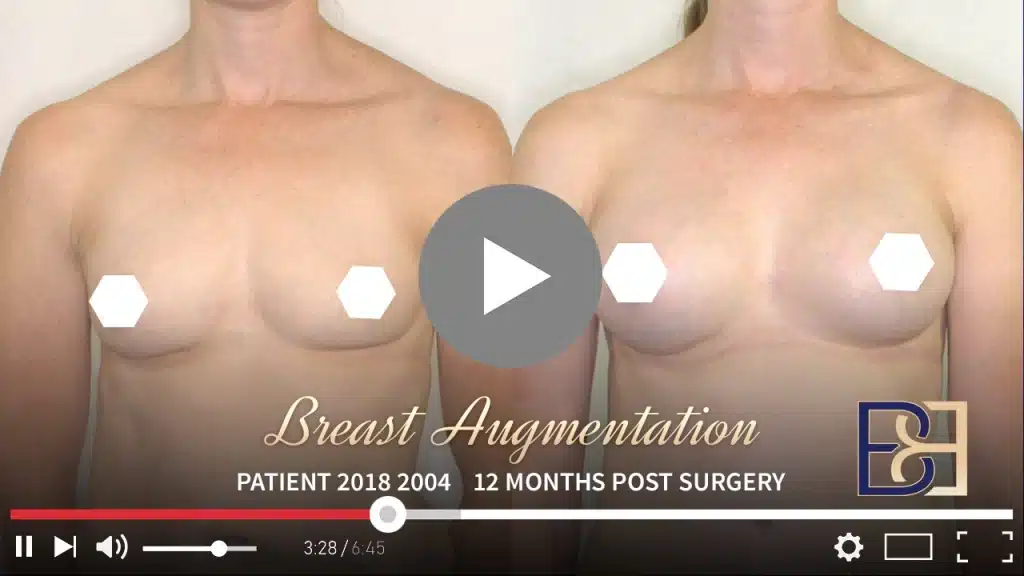 Patient 2018 2004 Breast Augmentation Drip Thumbnail