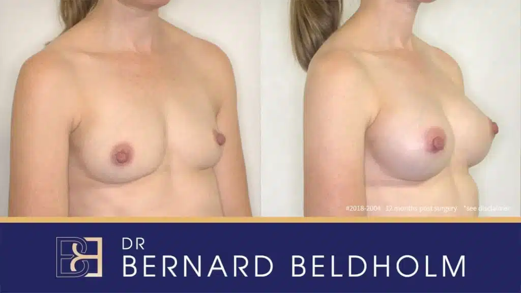 Patient 2018 2004 Breast Augmentation Left