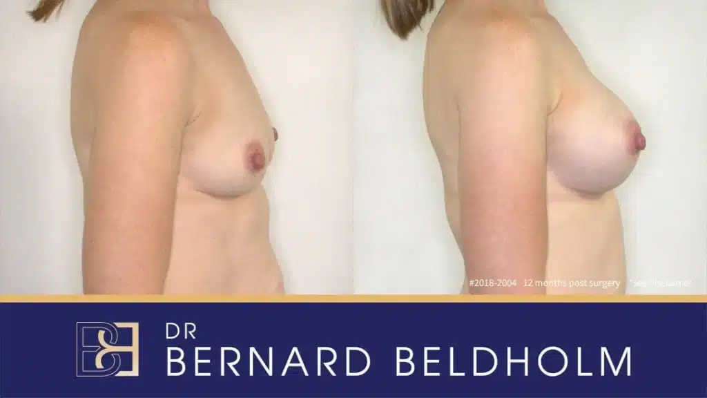 Patient 2018 2004 Breast Augmentation Side