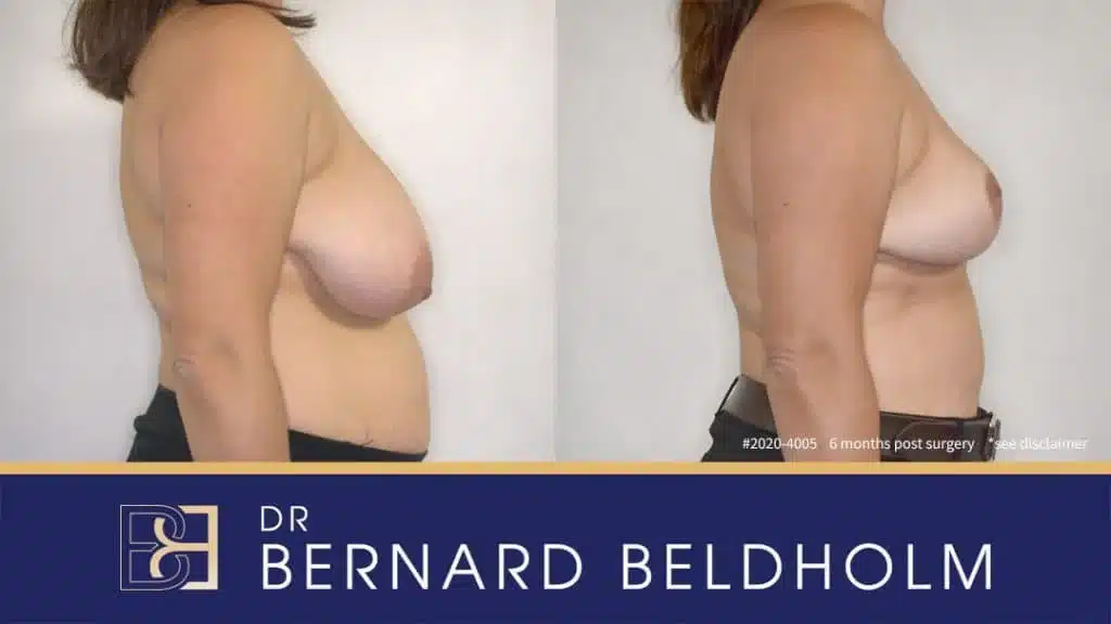 Patient 2020 4005 Breast Reduction Before After Side