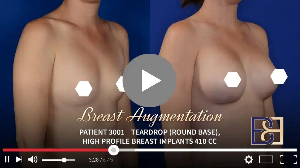 Patient 3001 Breast Augmentation Drip Thumbnail