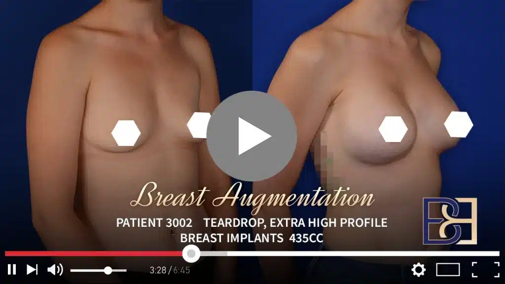 Patient 3002 Breast Augmentation Drip Thumbnail