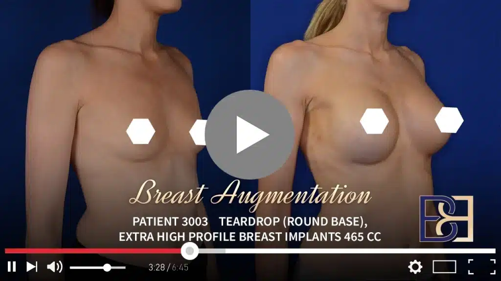 Patient 3003 Breast Augmentation Drip Thumbnail