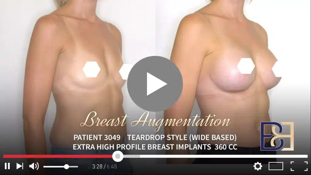 Patient 3049 Breast Augmentation Drip Thumbnail