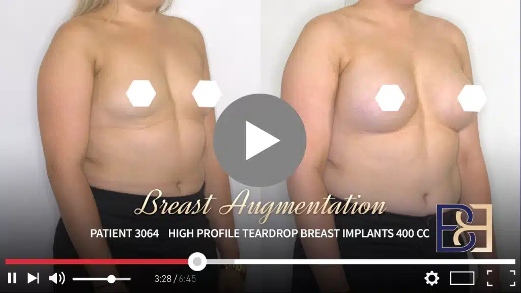 Patient 3064 Breast Augmentation Drip Thumbnail