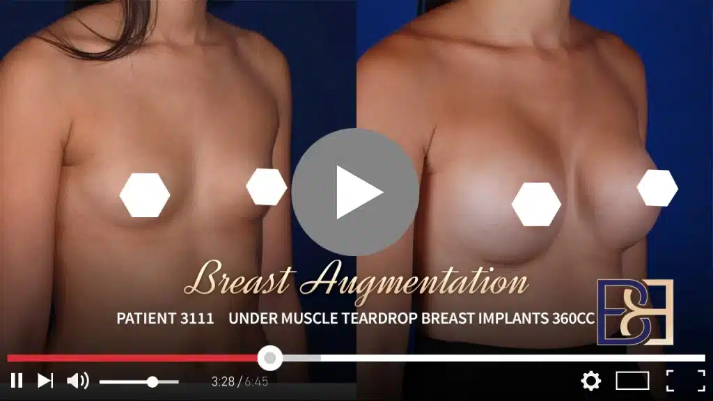 Patient 3111 Breast Augmentation Procedure Drip Thumbnail