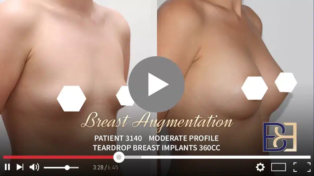 Teardrop Breast Implants (Augmentation Mammaplasty) Patient 3140