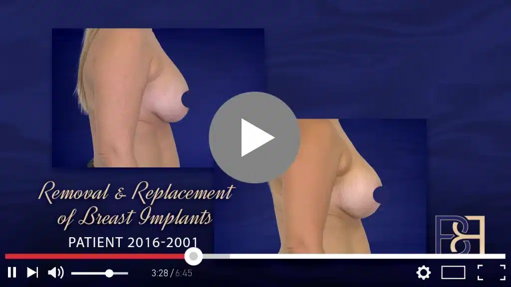 Patient 2016 2001 Removal Replacement of Implant Thumbnail