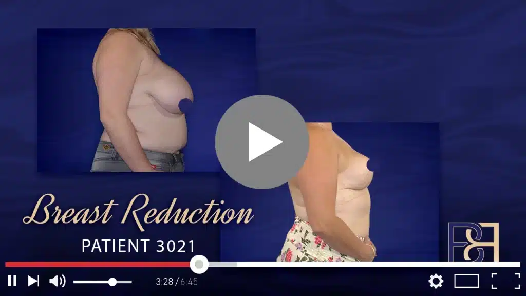Patient 3021 Breast Reduction Thumbnail