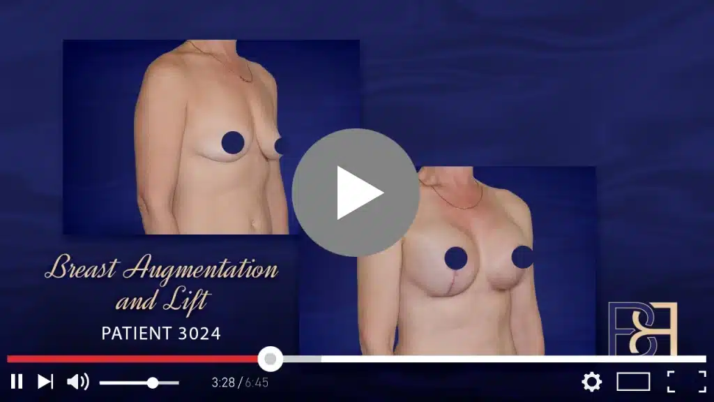 Patient 3024 Breast Augmentation Before After Thumbnail