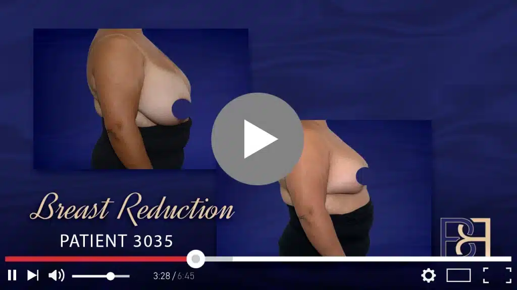 Patient 3035 Breast Reduction Thumbnail