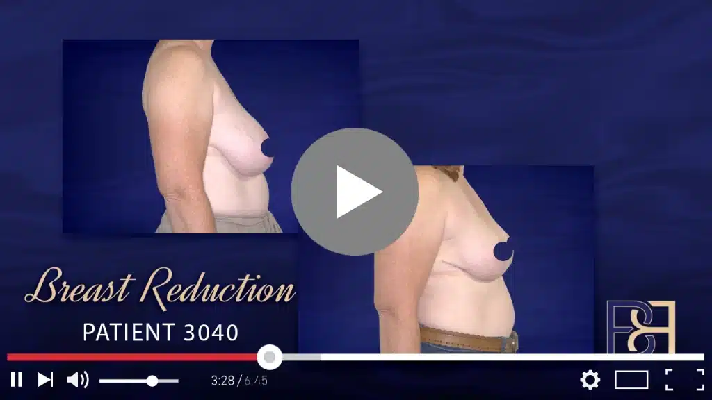 Patient 3040 Breast Reduction Thumbnail