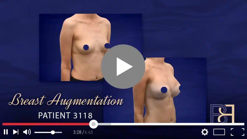 Teardrop Breast Implants (Augmentation Mammaplasty) Patient 3118