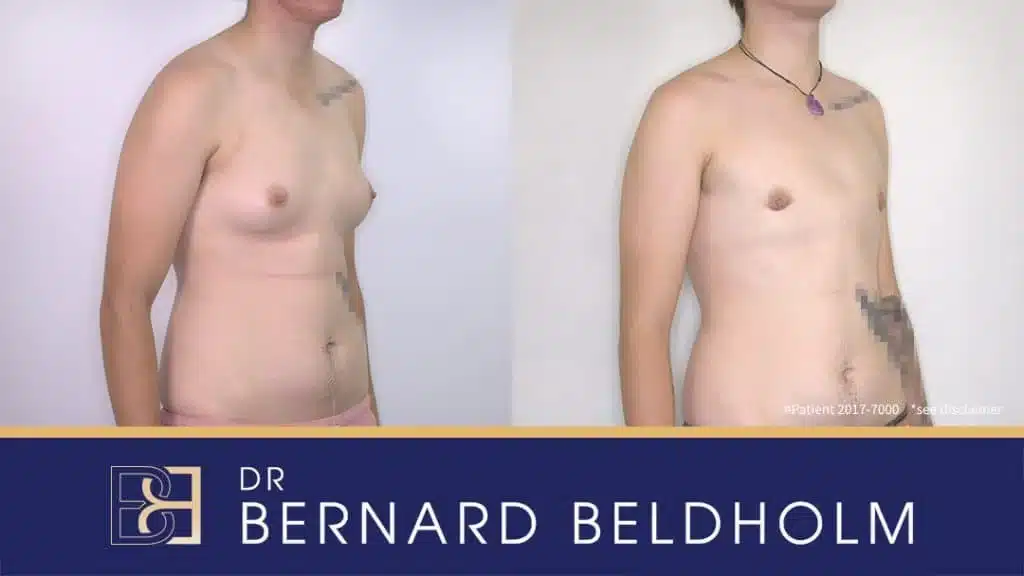 Gynaecomastia Surgery Patient 2017-7000