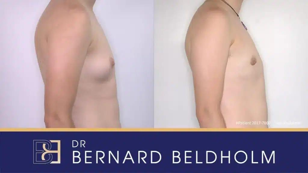 Gynaecomastia Surgery Patient 2017-7000