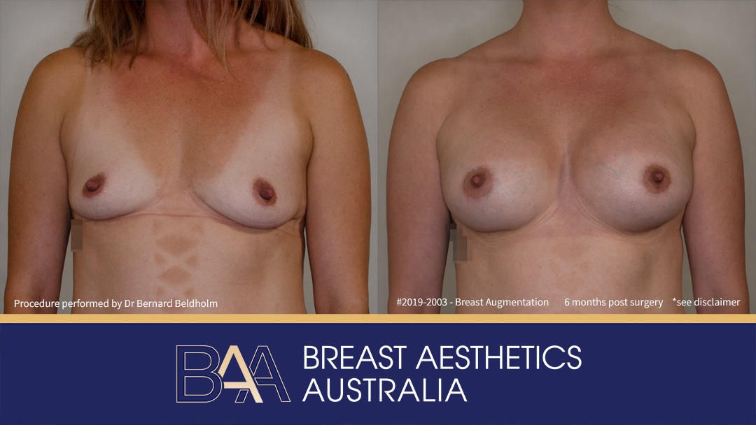 Patient 2019-2003 400cc Silicone Round Breast Implants (Augmentation Mammaplasty) Before & After - Front