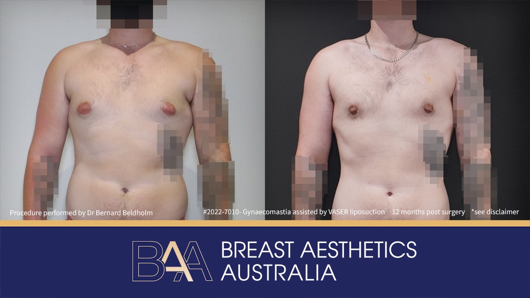 Patient 2022-7010 Gynaecomastia: VASER Liposuction + Gland Excision [BB grade 2a] Before & After - Front